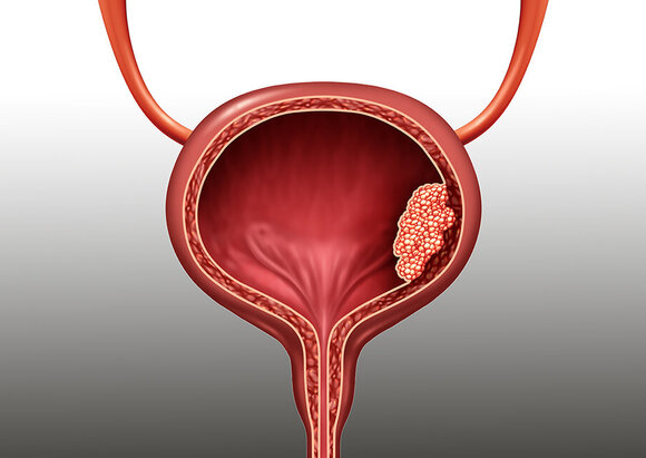 Behandlungsschwerpunkt Harnblasentumor