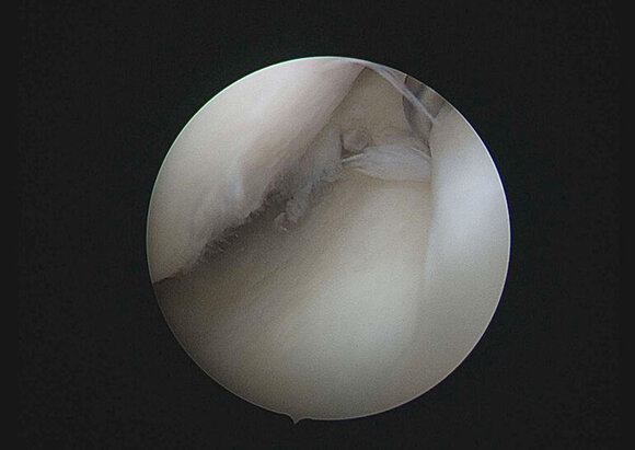 Behandlungsschwerpunkt Knorpelchirurgie Behandlungsschwerpunkt Knorpelchirurgie