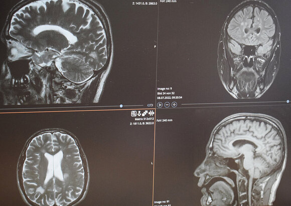 Behandlungsschwerpunkt Multiple Sklerose Behandlungsschwerpunkt Multiple Sklerose