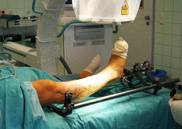 Behandlungsschwerpunkt Knochenbruchbehandlung Behandlungsschwerpunkt Knochenbruchbehandlung