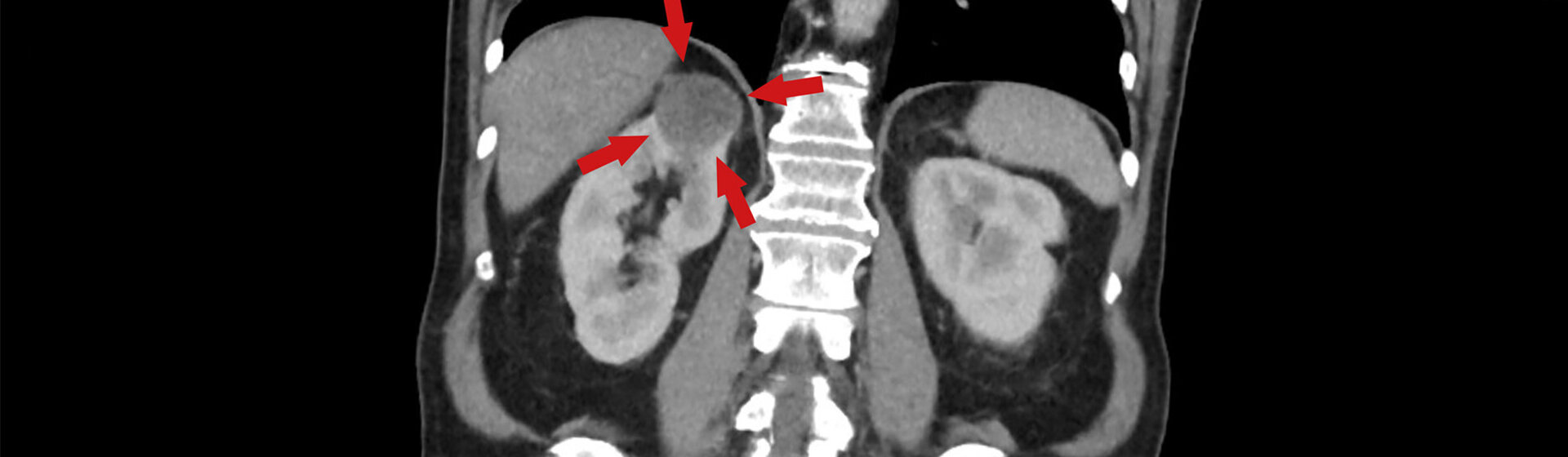 Röntgenbild eines Nierentumors