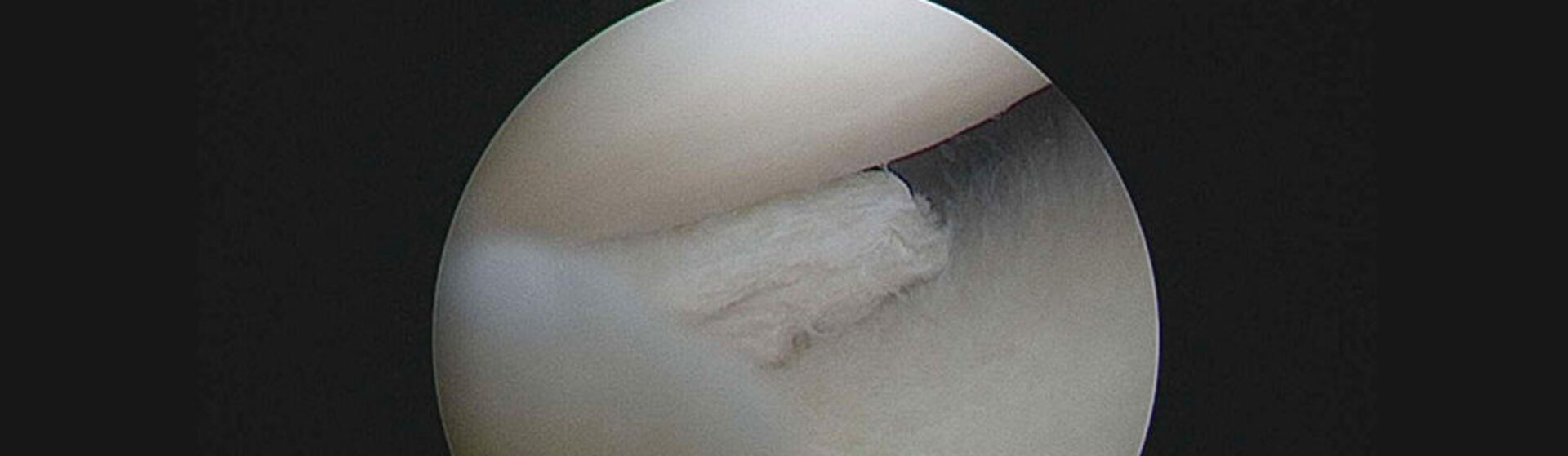 Foto von einer Spiegelung im Inneren eines Gelenkes. Foto von einer Spiegelung im Inneren eines Gelenkes.