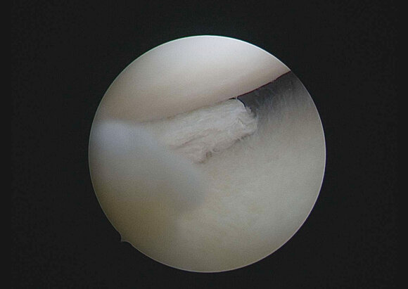 Behandlungsschwerpunkt Arthroskopie Behandlungsschwerpunkt Arthroskopie