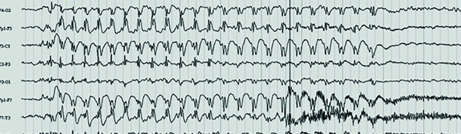 Abbildung eines EEG-Kurvendiagramms.