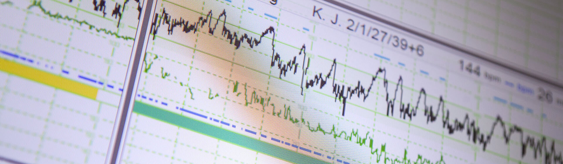 Abbildung eines Überwachungs-EKG. Abbildung eines Überwachungs-EKG.