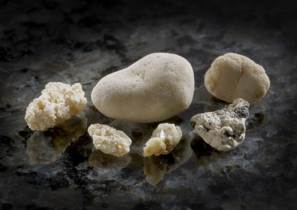 Behandlungsschwerpunkt Steinerkrankungen