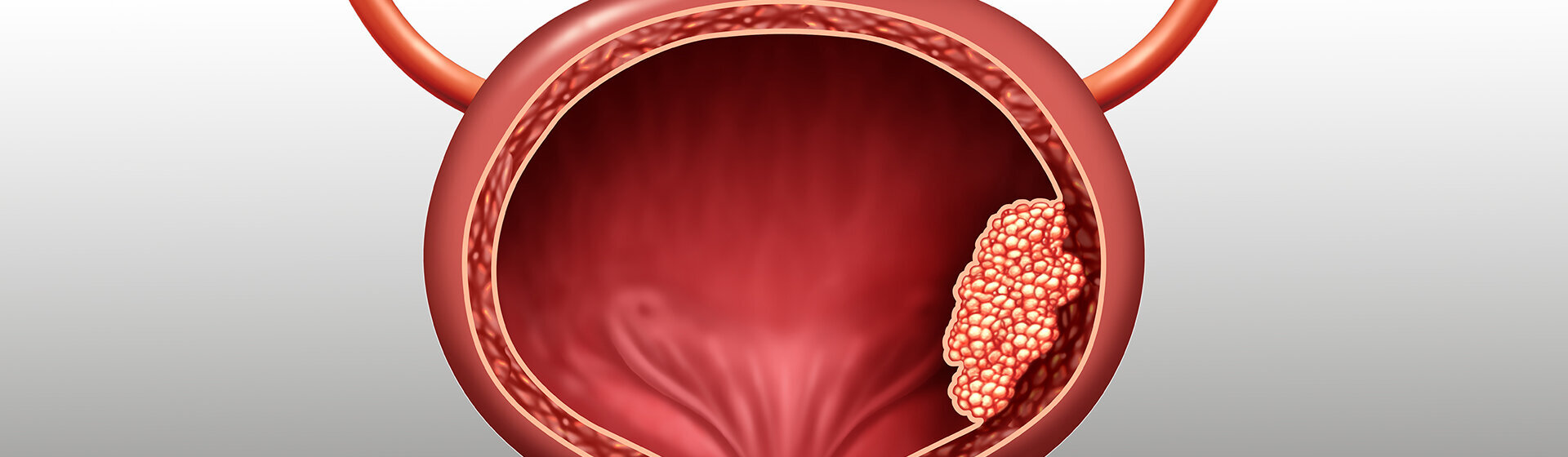 Schematische Darstellung der Harnblase mit Tumor