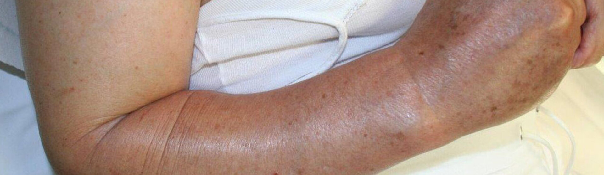 Großaufnahme eines entzündeten Arms.