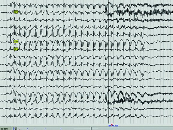 Abbildung eines EEG-Kurvendiagramms.