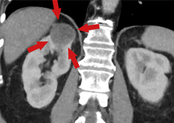 Behandlungsschwerpunkt Nierentumor